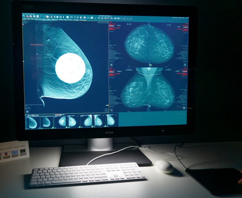 Barco Mammogram with implant